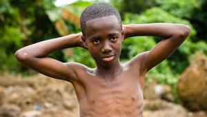 Malnutrition